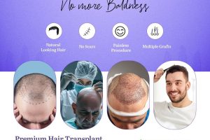Hair transplant in Baku